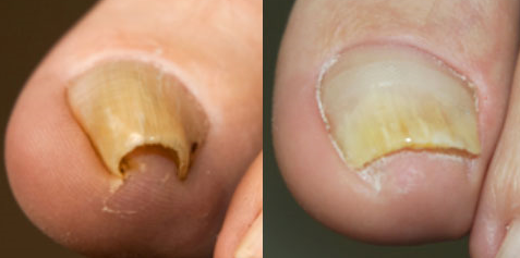 Ingrown Nail Treatment